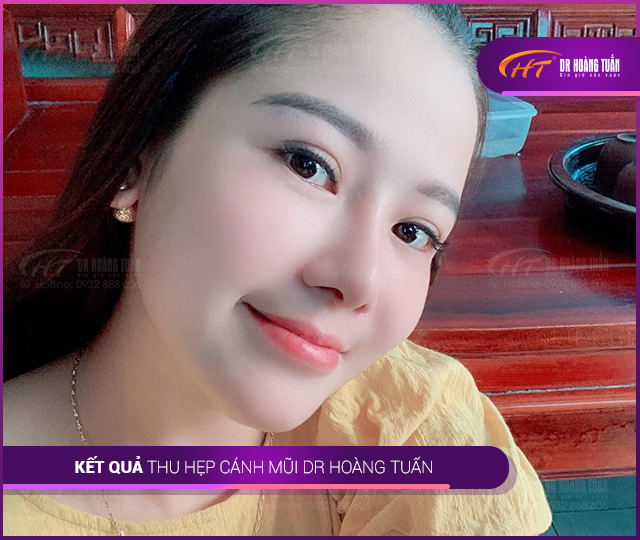 Kết quả phẫu thuật làm gọn cánh mũi 